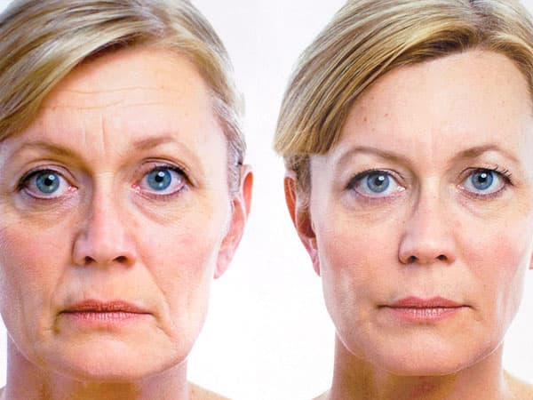 Rellenos de hialurónico